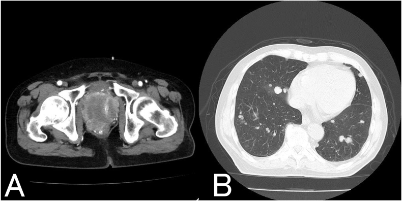 Dual paraneoplastic syndrome with prostate cancer: A case of syndrome of inappropriate secretion of antidiuretic hormone (SIADH) and humoral hypercalcemia of malignancy (HHM).