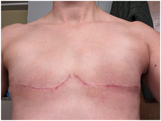 "When I Look in the Mirror, I Want to See a Healthy Body": The Lived Experience of Young Previvors, Bilateral Risk-Reducing Mastectomy, and Body Image.