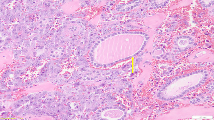 Thyroid angiosarcoma: a rare malignancy - case report and systematic review of the literature.