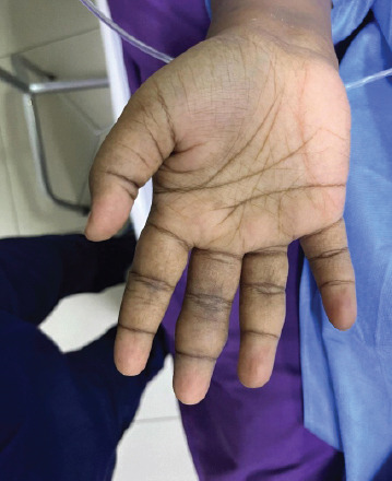 Don't Dismiss the Swelling: A Rare Case of Tenosynovial Giant Cell Tumor in a Young Woman's Finger - A Case Report.