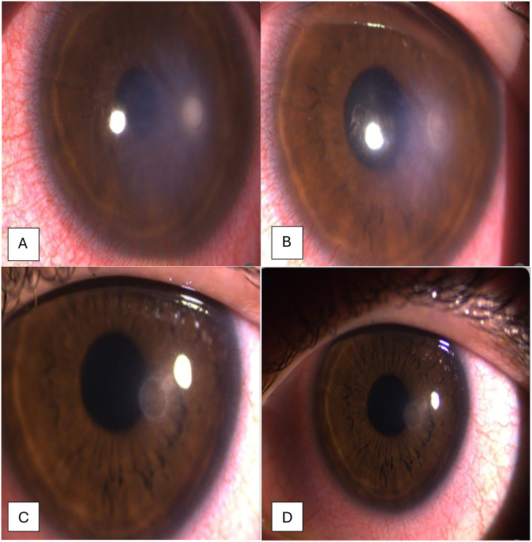 Contact Lens-Associated <i>Serratia marcescens</i> Keratitis: A Case Report.