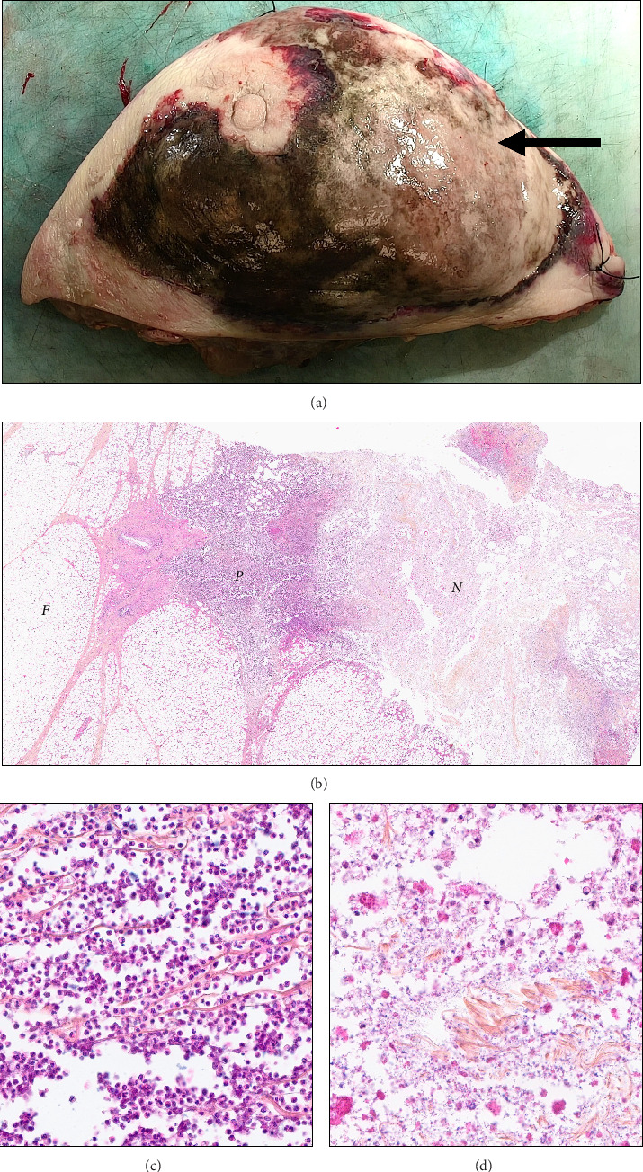 Bacterial Synergism in Breast Necrotizing Fasciitis: A Case Report on Diagnostic Dilemmas, Therapeutic Challenges, and Reconstructive Management.