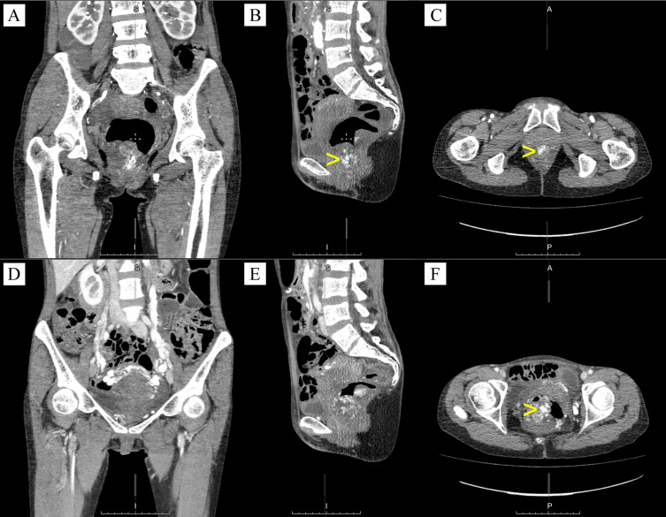 Isolated Colorectal Involvement in Klippel-Trenaunay Syndrome: A Case of Extensive Vascular Malformation.