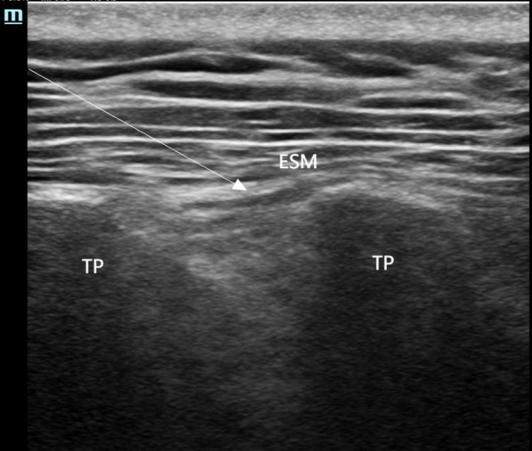 Impact of Posterior Quadratus Lumborum Block on Acute Pain Relief and Chronic Pain Prevention in Breast Cancer Surgery.