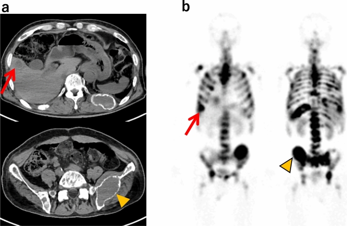Analysis of clinical factors associated with incomplete standard protocol <sup>177</sup>Lu-DOTATATE treatment in neuroendocrine tumor patients.