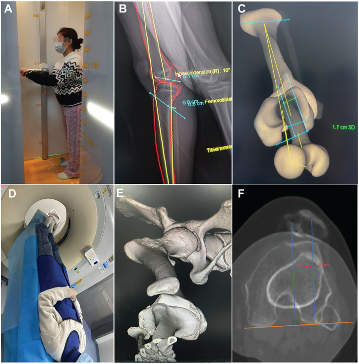 Reliability and Reproducibility of the EOS 3D Imaging System in Measuring TT-TG Distance in Patients With Recurrent Patellar Dislocation.