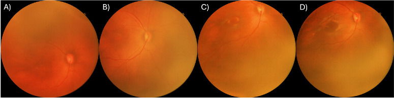 Foveal Identification and Development in Prematurity-Implications on Zone Localization and Nutritional Supplementation.