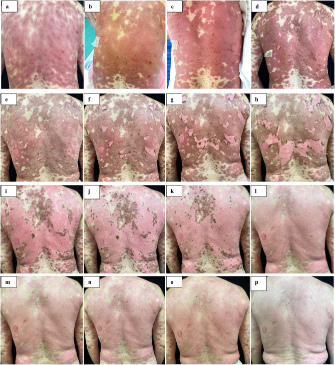 Upadacitinib Coadministered with Methylprednisolone for Effective Treatment of SJS/TEN Overlap Syndrome: A Case Report.