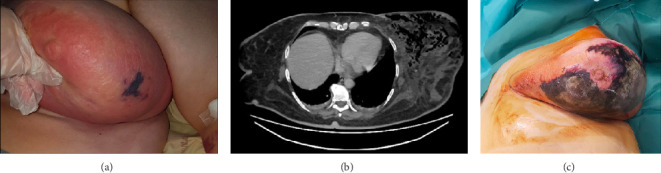 Bacterial Synergism in Breast Necrotizing Fasciitis: A Case Report on Diagnostic Dilemmas, Therapeutic Challenges, and Reconstructive Management.