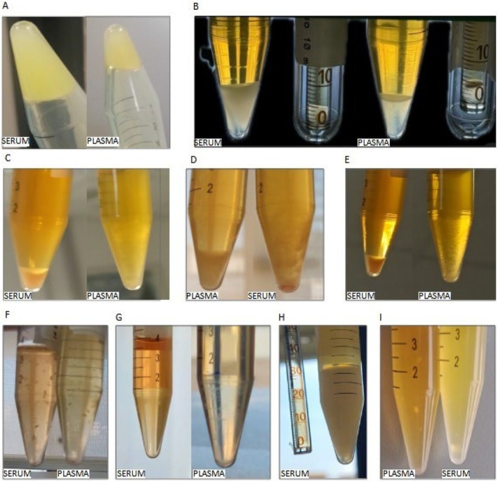 Laboratory Practices for the Detection and Characterization of Cryoglobulins and Cryofibrinogen.