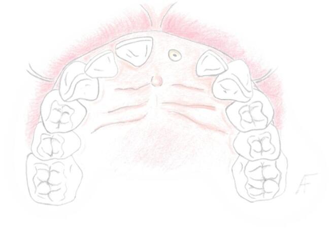 The low invasiveness design (LID) flap in immediate implant placement: a 20-patient case series on a novel flap design based on new insights into papilla vascularization.
