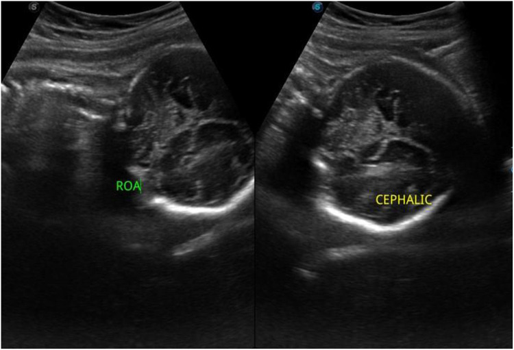 Conservative Treatment of Third Trimester Appendicitis Misdiagnosed as Round Ligament Pain. A Case Report and Review of the Literature in a Resource-Limited Setting.