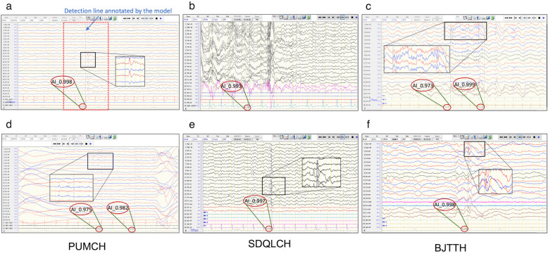 Development and validation of a multimodal automatic interictal epileptiform discharge detection model: a prospective multi-center study.