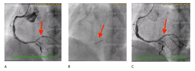 Drug-Coated Balloons for Coronary Interventions: A Focused Review.