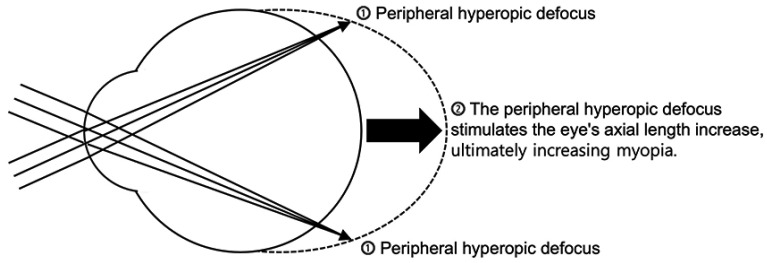 Myopia: a review of current concepts, association with nonophthalmological conditions, and treatment strategy in children and adolescents.
