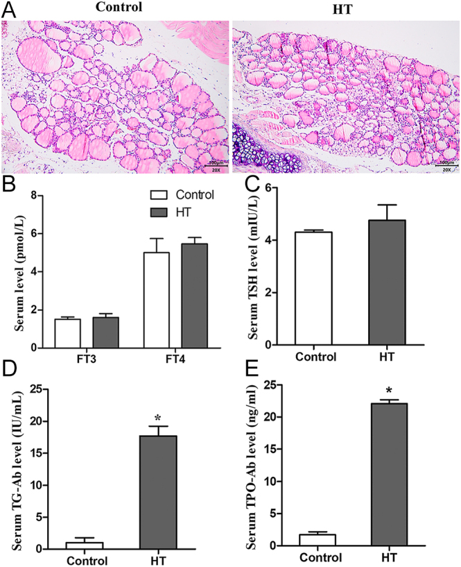 Endoplasmic reticulum stress contributes to insulin resistance in Hashimoto's thyroiditis.