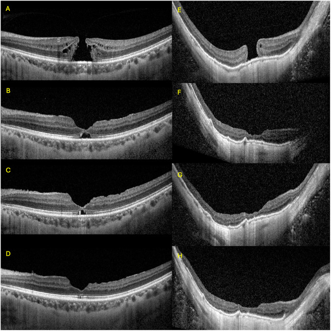 Internal Limiting Membrane Flap Enhances Macular Hole Closure Rates in Highly Myopic Eyes: A Case-Control Study.