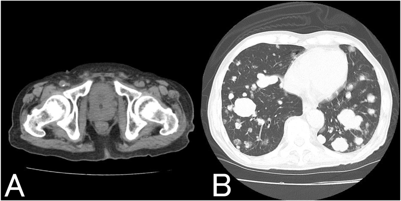 Dual paraneoplastic syndrome with prostate cancer: A case of syndrome of inappropriate secretion of antidiuretic hormone (SIADH) and humoral hypercalcemia of malignancy (HHM).