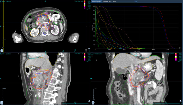 Investigating the Efficacy and Safety of the CyberKnife System for Treating Primary Pancreatic Cancer with Metastases to the Gastrointestinal Tract.