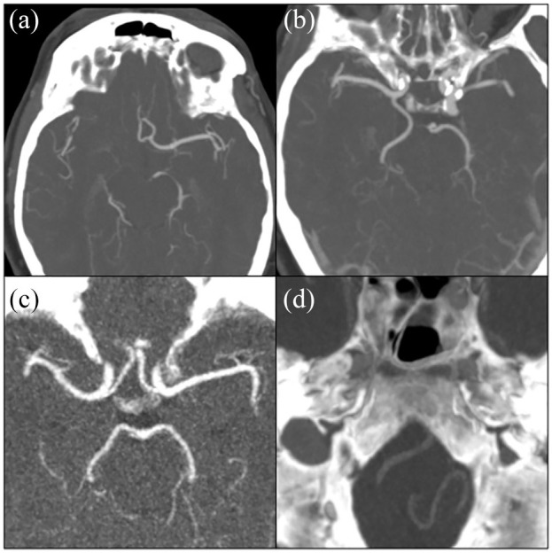 Variations in intracranial arterial anatomy of the circle of Willis and their association with arteriosclerosis in patients with ischemic cerebrovascular disease.