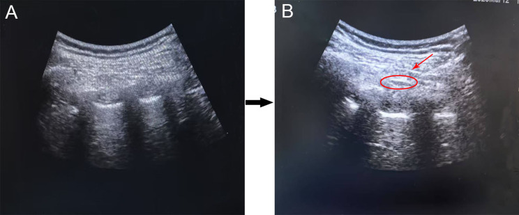 Efficacy of Dexmedetomidine as an Adjuvant to Ropivacaine for Intercostal Nerve Block in Elderly Patients Undergoing Video-Assisted Thoracoscopic Esophagectomy: A randomized Double-Blinded Trial.