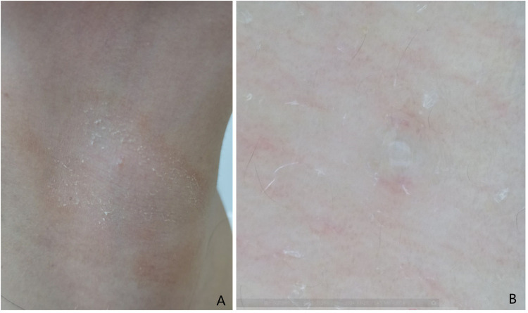 Meyerson's Phenomenon Induced by Molluscum Contagiosum in an Adult: A Rare Case Report.