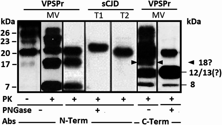 Variably protease-sensitive prionopathy: mass spectrometry analysis of the pathogenic prion protein provides a new perspective.