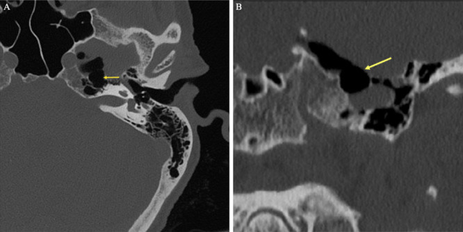 Life-threatening pneumocephalus from middle ear defect causing cerebrospinal fluid leakage into the eustachian tube: illustrative case.