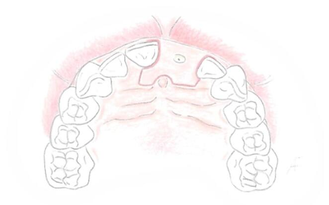 The low invasiveness design (LID) flap in immediate implant placement: a 20-patient case series on a novel flap design based on new insights into papilla vascularization.
