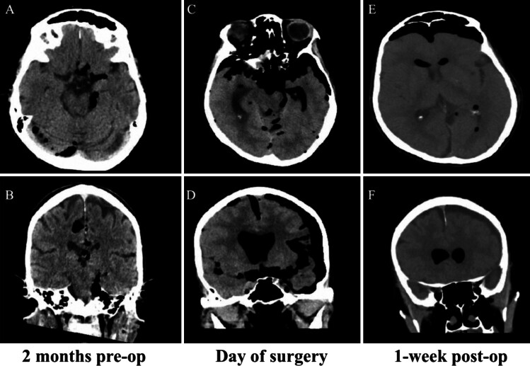 Life-threatening pneumocephalus from middle ear defect causing cerebrospinal fluid leakage into the eustachian tube: illustrative case.