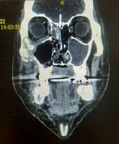 Case Series of Post-COVID-19 Mucormycosis in Serbia/Rhino-Orbital-Cerebral Form: Surgical and Medical Treatment.