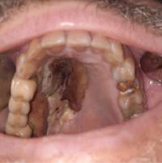 Case Series of Post-COVID-19 Mucormycosis in Serbia/Rhino-Orbital-Cerebral Form: Surgical and Medical Treatment.
