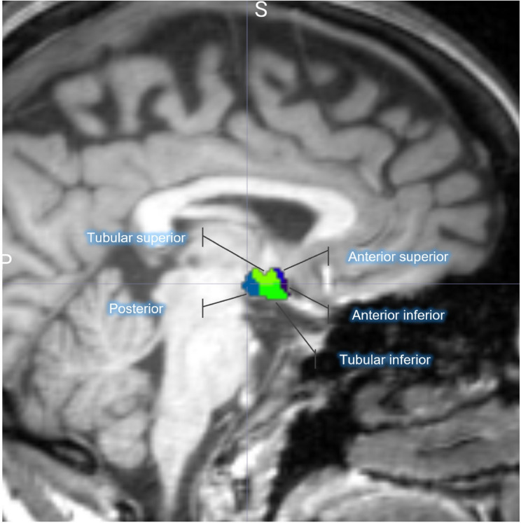 Volume of the hypothalamus and its subunits in patients with episodic migraine without aura during interictal periods.