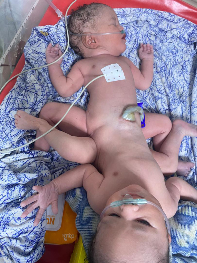 Ischiopagus Conjoint Twins: A Case Report.