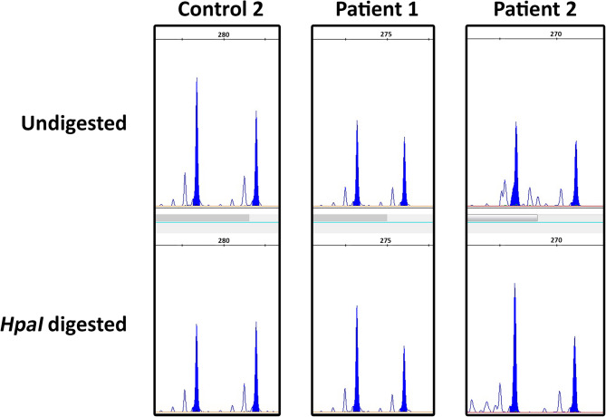 Random X chromosome inactivation in female Charcot-Marie-Tooth disease type X1: insights from sural nerve biopsy analysis.