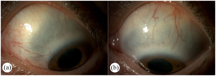Clinical spectrum and management of anterior scleritis: case reports.