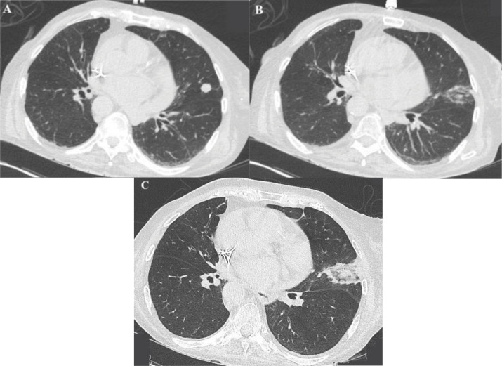 Microwave Ablation of Pulmonary Carcinoid Tumor: A Therapeutic Alternative for Inoperable Cases.