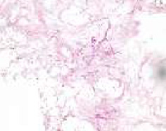 Case Series of Post-COVID-19 Mucormycosis in Serbia/Rhino-Orbital-Cerebral Form: Surgical and Medical Treatment.