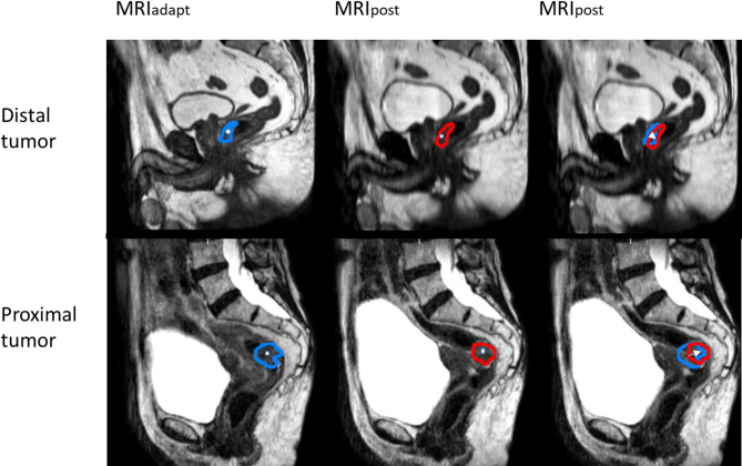 From standardized to individualized margins for online adaptive tumor dose escalation in rectal cancer.