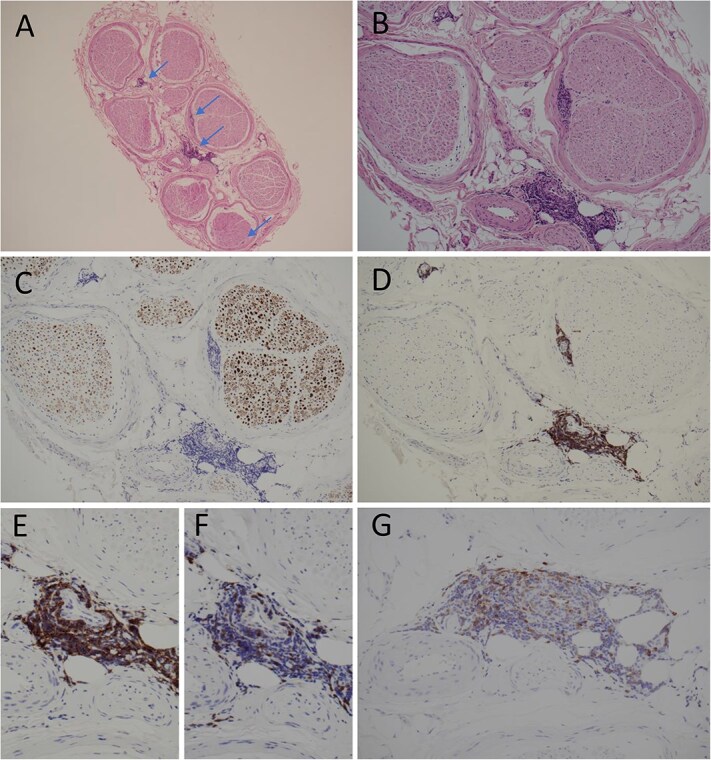 An 80-year-old female with multiple mononeuropathy: neuroleukemiosis a rare complication of chronic lymphocytic leukaemia.