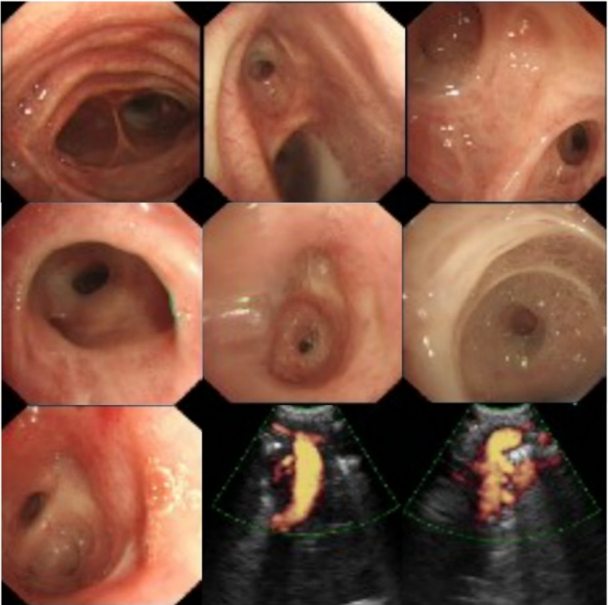 A case of tracheobronchomegaly misdiagnosed as COPD: case report and literature review.