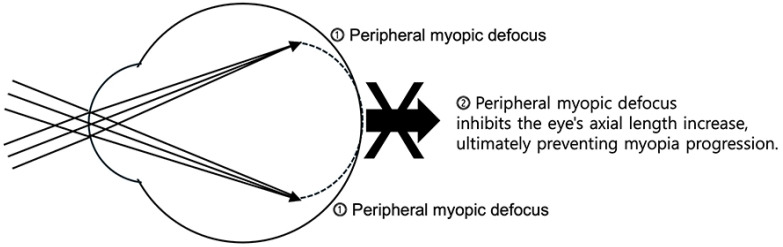 Myopia: a review of current concepts, association with nonophthalmological conditions, and treatment strategy in children and adolescents.