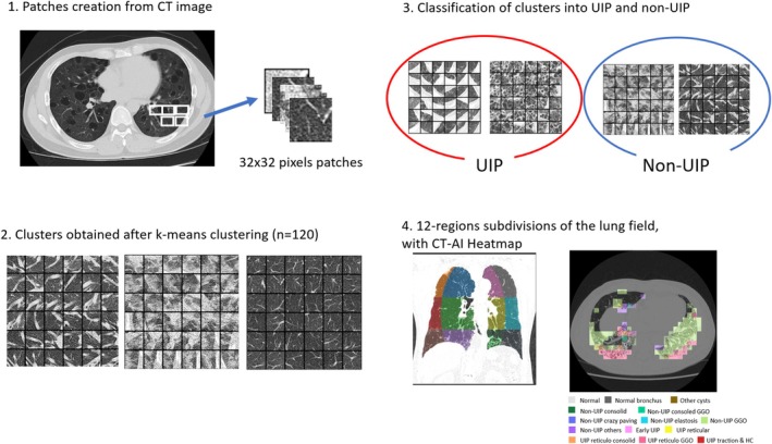 Enhancing Interstitial Lung Disease Diagnoses Through Multimodal AI Integration of Histopathological and CT Image Data.