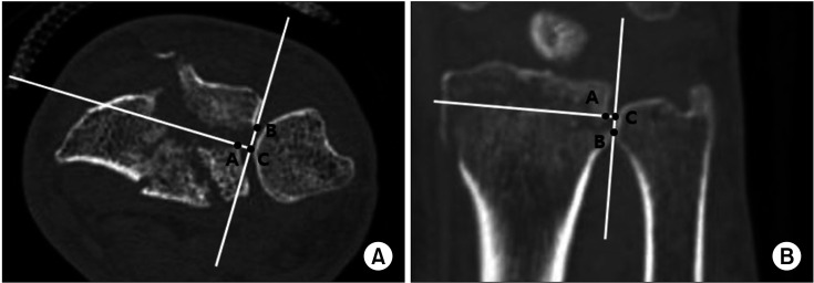 The Impact of Sigmoid Notch Involvement on the Outcomes of Distal Radius Fractures: Radiological and Clinical Assessments after a Minimum of 5 Years of Follow-up.