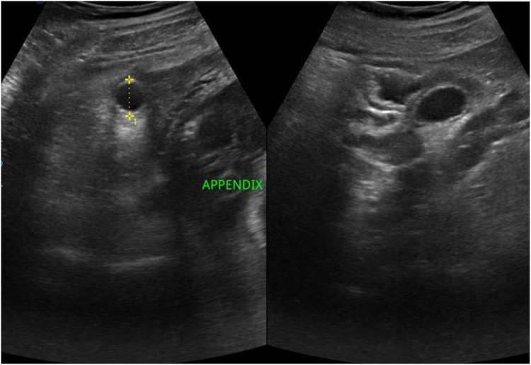 Conservative Treatment of Third Trimester Appendicitis Misdiagnosed as Round Ligament Pain. A Case Report and Review of the Literature in a Resource-Limited Setting.