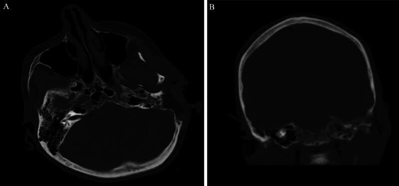 Life-threatening pneumocephalus from middle ear defect causing cerebrospinal fluid leakage into the eustachian tube: illustrative case.