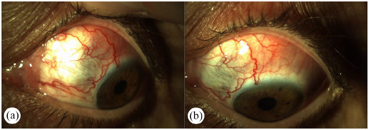 Clinical spectrum and management of anterior scleritis: case reports.