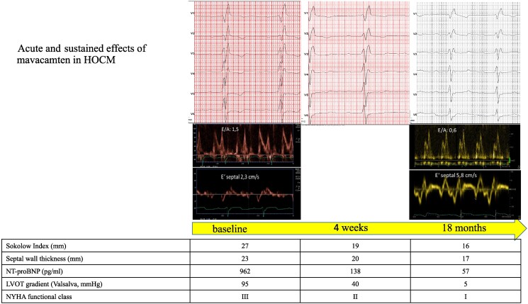 Comprehensive improvement in cardiac function following myosin inhibition after the ineffectiveness of myectomy and alcohol septal ablation: a case report.
