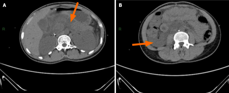 Convergence of diabetic ketoacidosis, acute pancreatitis, and malaria: A case report.