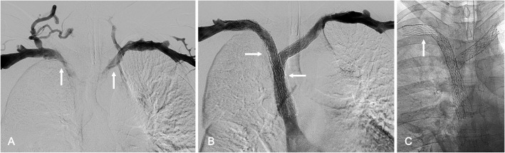 Dedicated venous stent placement across the thoracic outlet: will novel venous stents transform axillosubclavian vein thrombosis treatment paradigm?